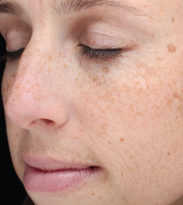 Forever Young BBL Non-Surgical Skin Tightening | Visage Dermatology