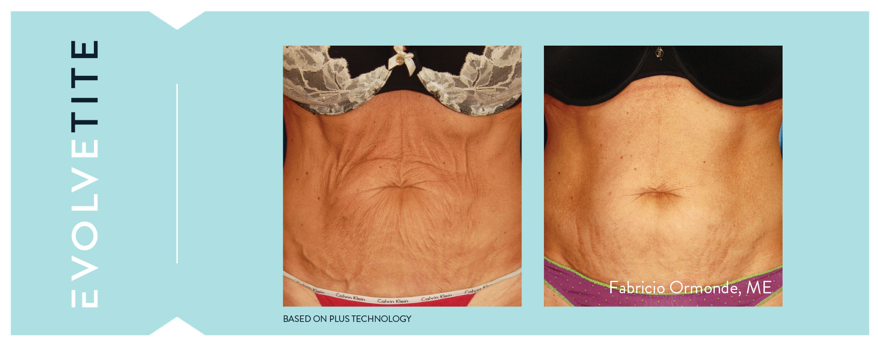 Evolve Tite Before and After - Visage Dermatology